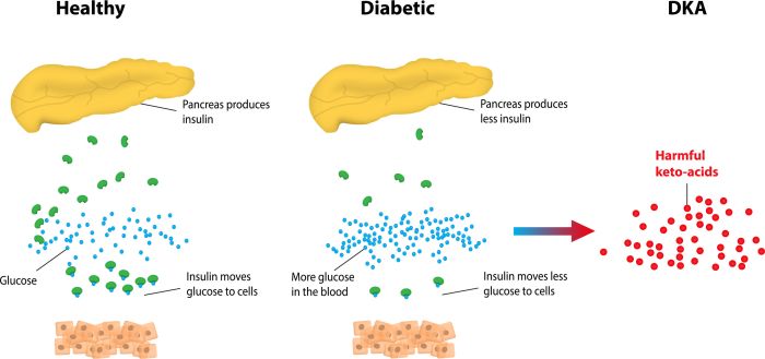 A complication of diabetes mellitus where fats are improperly burned